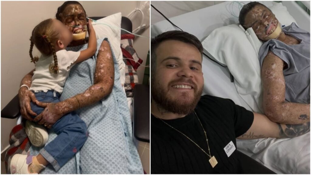 Xeroderma pigmentoso: a rara condição genética que transforma a luz solar em risco fatal