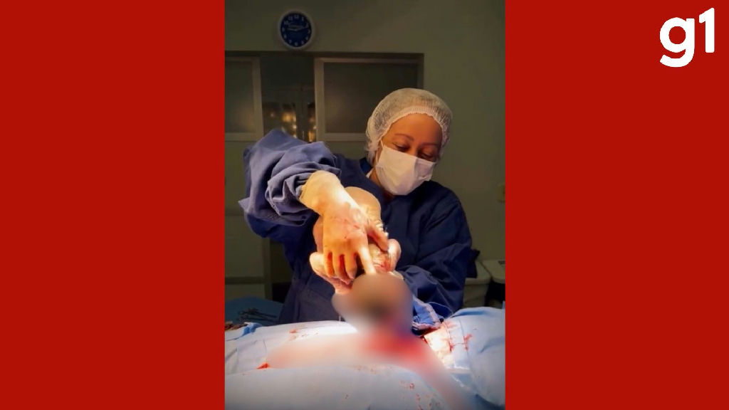 Parto empelicado raro é registrado em hospital de Sorriso